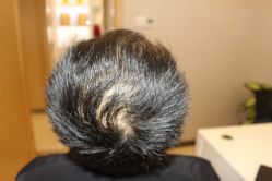 -大麦微针植发丨全国连锁