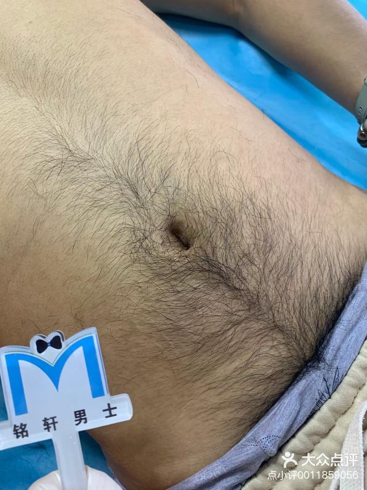 男士脱毛哪家强