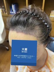 -大麦微针植发全国连锁