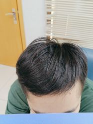 -大麦微针植发丨全国连锁