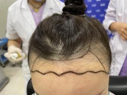 -碧莲盛·不剃发植发