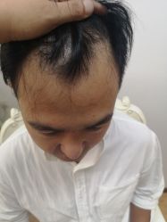 点击看大图 -大麦微针植发丨全国连锁