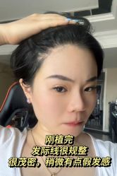 -碧莲盛·不剃发植发