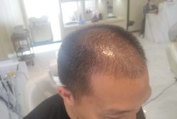 -大麦微针植发丨全国连锁