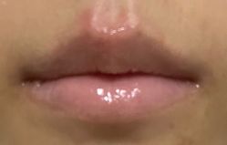 体验后-More摩尔医美の注射线雕光电中心