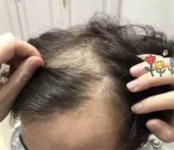 点击看大图 -大麦微针植发全国连锁