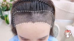 -大麦微针植发丨全国连锁