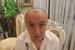 点击看大图 -大麦微针植发丨全国连锁