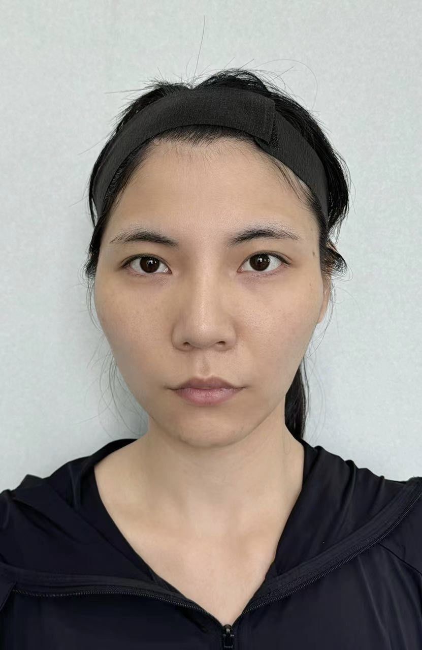 我是典型的凹凸凹面型,太阳穴凹,颧骨凸,脸颊凹谁懂啊,明明脸不大,看