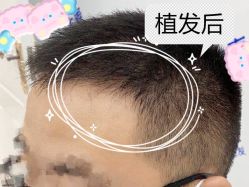 -大麦微针植发全国连锁