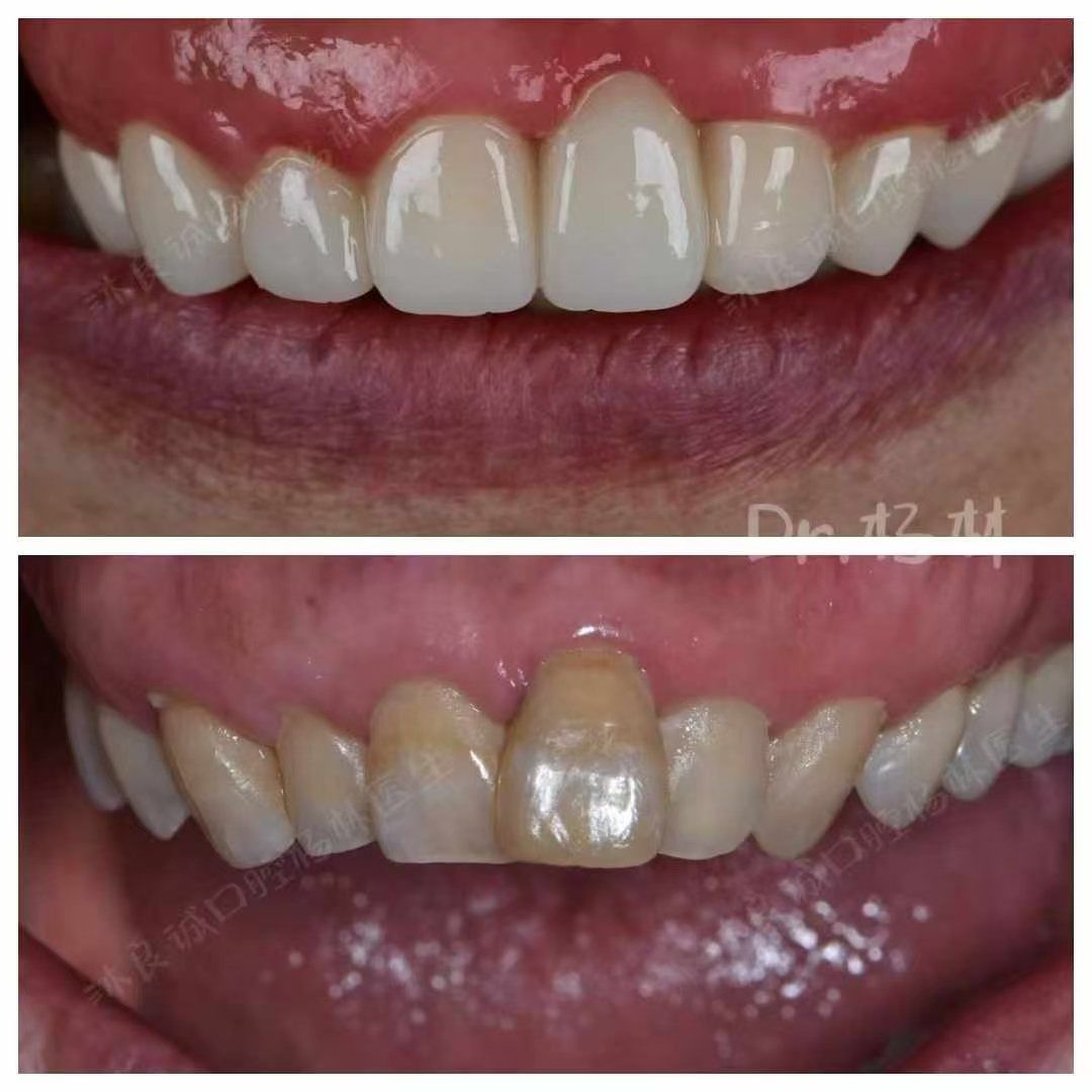 前牙牙冠修复,让你的微笑越来越精致!