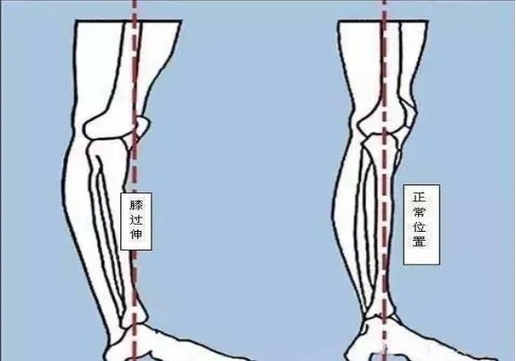 屈膝和伸膝动作示意图图片