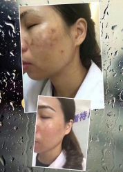 -蕾特恩专业祛痘国际连锁