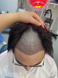 -大麦微针植发全国连锁