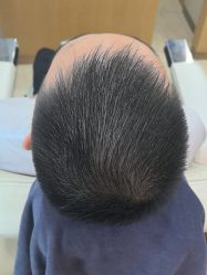 点击看大图 体验后-大麦微针植发全国连锁