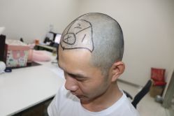 -大麦微针植发丨全国连锁