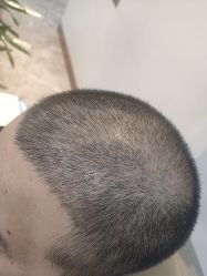 -碧莲盛·不剃发植发
