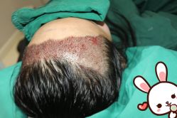 点击看大图 -大麦微针植发丨全国连锁