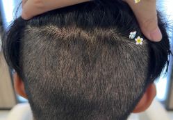 -大麦微针植发全国连锁