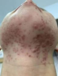 -瑶芳清颜草本祛痘