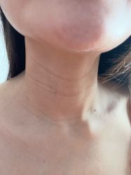 体验前-小忠丽格医美