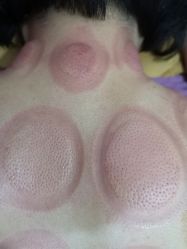 -苗塑堂减肥艾灸