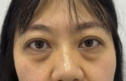 -天津健丽·去眼袋医疗美容机构