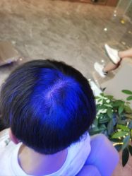 -碧莲盛·不剃发植发