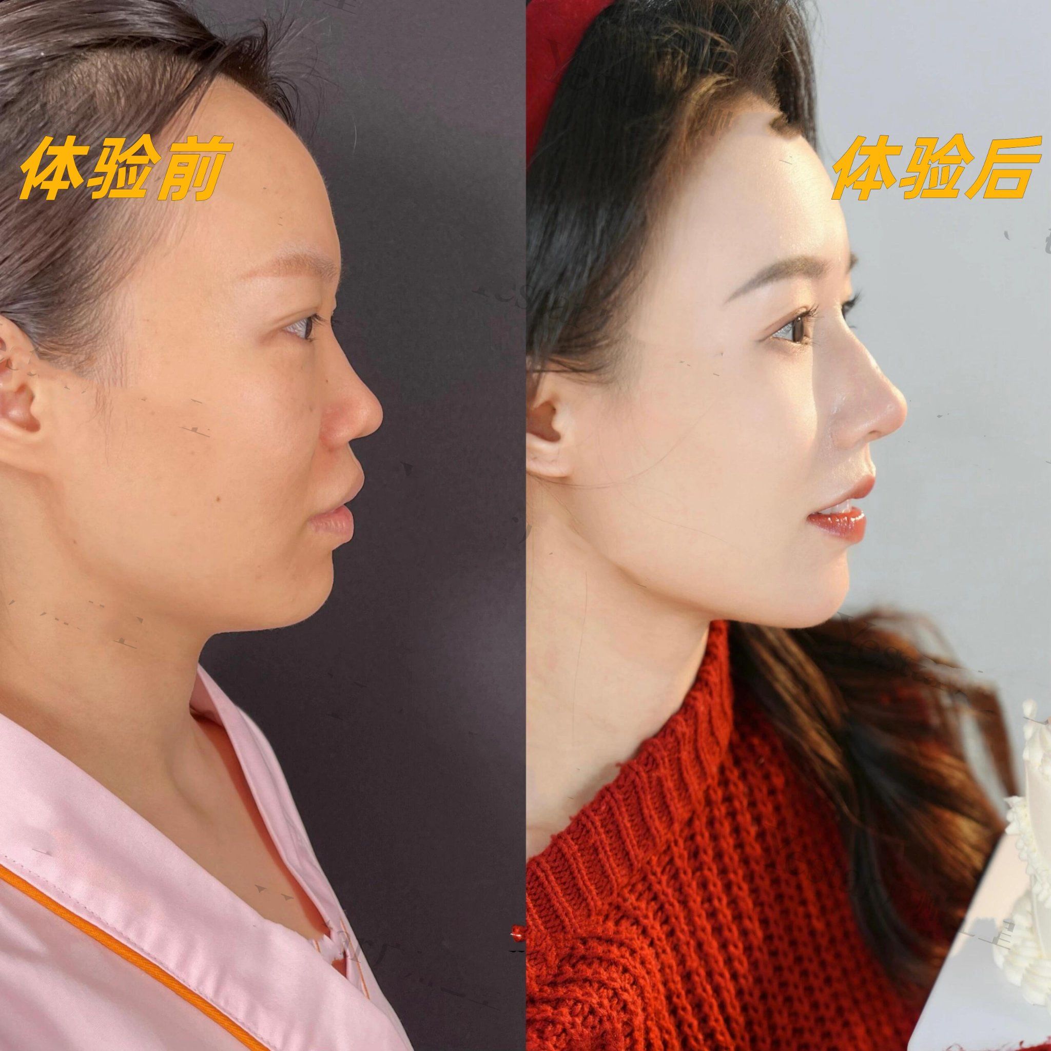 鼻综合术后对比绝了