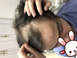 点击看大图 -大麦微针植发丨全国连锁