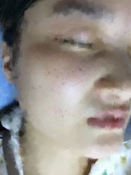 -爱莎扁平疣·汗管瘤·斑痣中心
