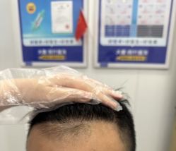 -大麦微针植发全国连锁