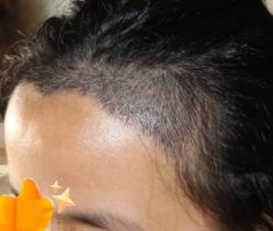 -大麦微针植发丨全国连锁