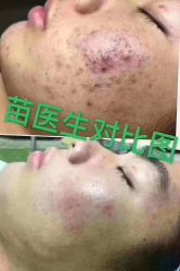 -苗医生草本科技祛痘