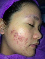 -蕾特恩专业祛痘