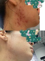 -安那般那皮肤年轻化ANAPANA