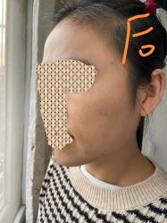 体验后-小忠丽格医美