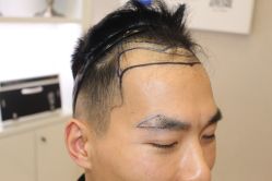 -大麦微针植发丨全国连锁