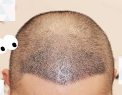 -大麦微针植发全国连锁