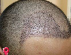 -大麦微针植发丨全国连锁