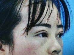 体验后-西安壹加壹医疗美容·西北抗衰旗舰店