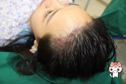 -大麦微针植发丨全国连锁