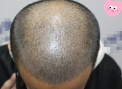 -大麦微针植发丨全国连锁