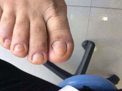 -德哥灰指甲脚气甲沟炎跖疣护理