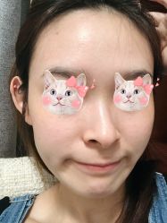 体验后-慕颜医疗美容·皮肤微整 抗衰
