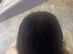 -碧莲盛·不剃发植发