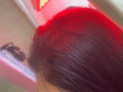 -碧莲盛·不剃发植发