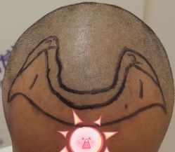 -大麦微针植发全国连锁