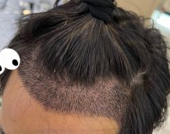 -大麦微针植发全国连锁