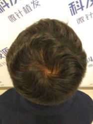 点击看大图 -大麦微针植发丨全国连锁